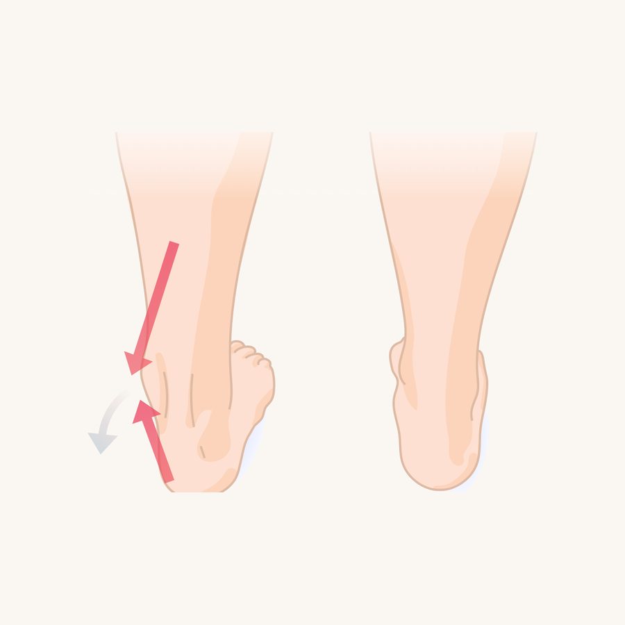 Drawing of two feet from behind: one rolling inward, one in a neutral position