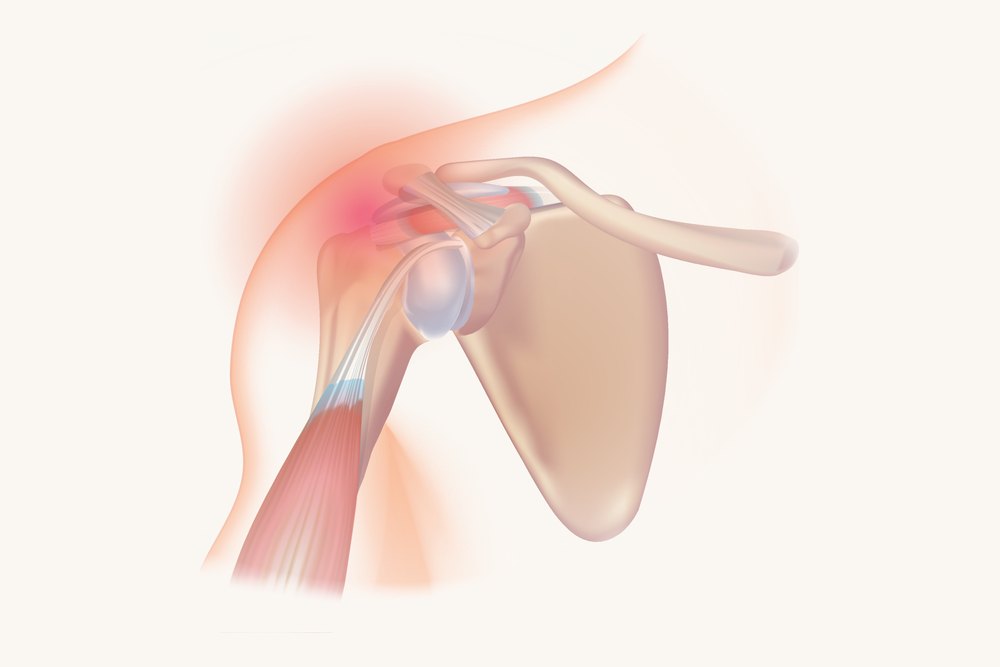 A drawing of the shoulder joint with the sore area marked