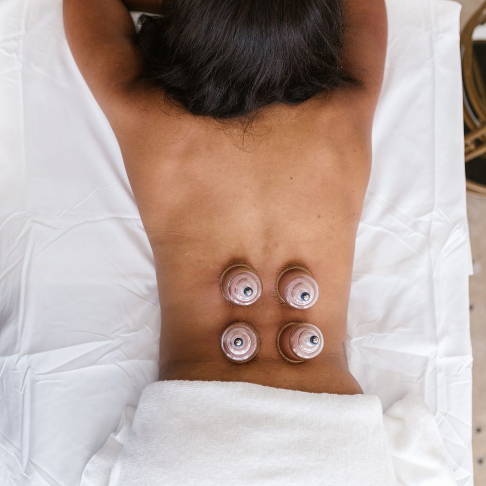 Four cups set on a patient's lower back, seen from above